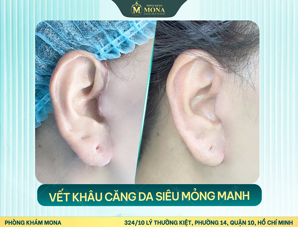 CĂNG DA MẶT SMAS