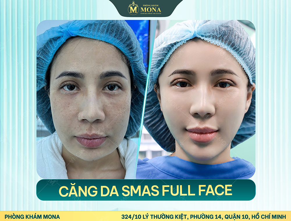 CĂNG DA MẶT SMAS
