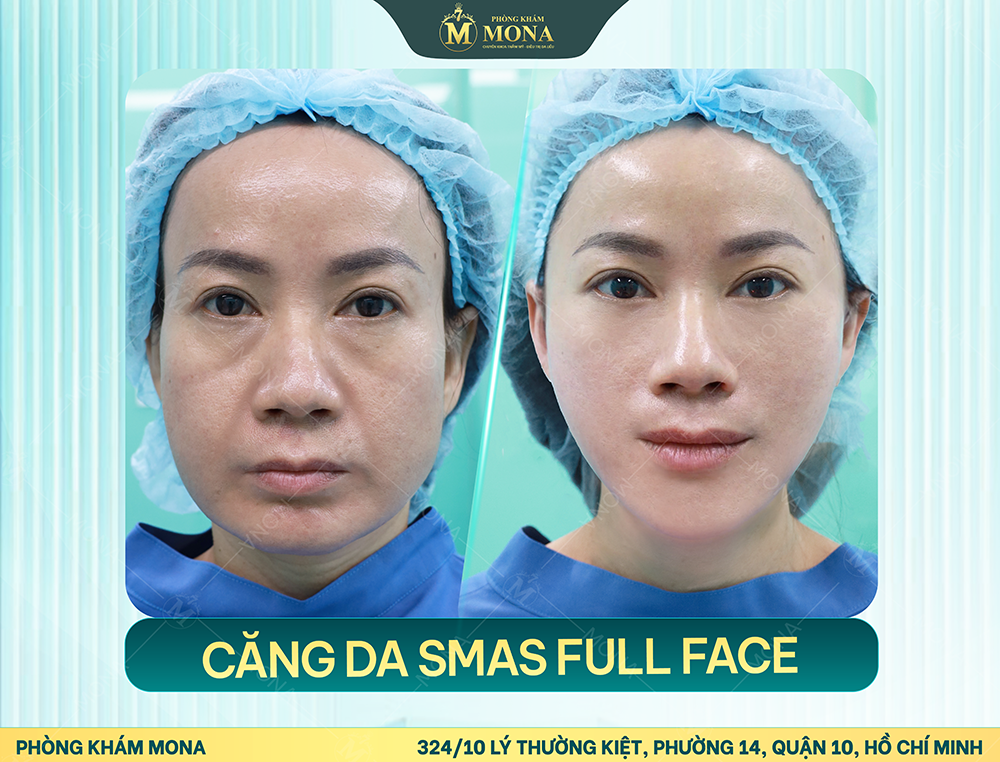 CĂNG DA MẶT SMAS