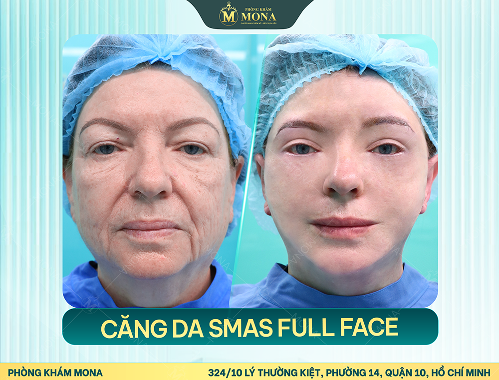 CĂNG DA MẶT SMAS
