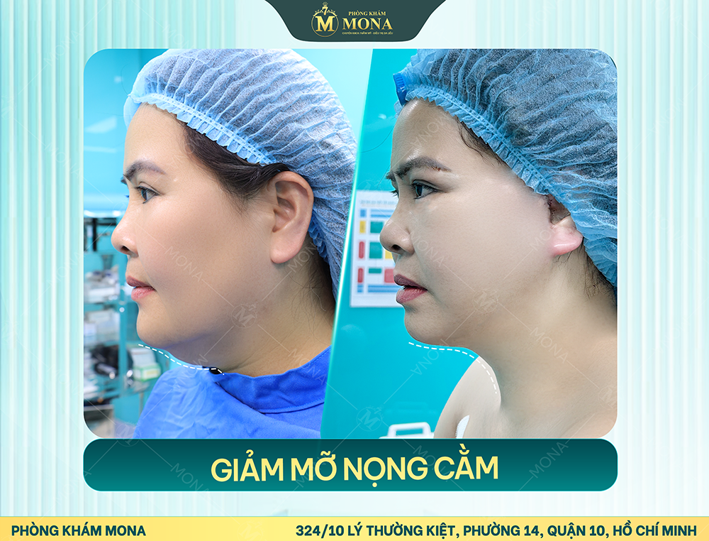 GIẢM MỠ NỌNG CẰM