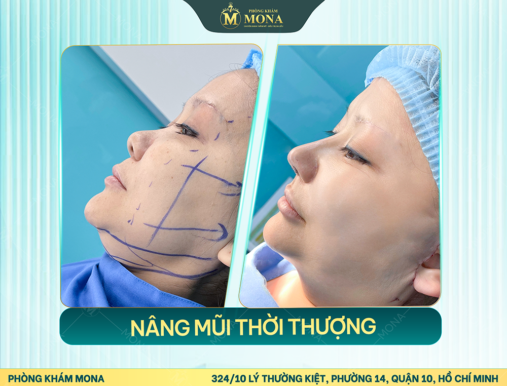 NÂNG MŨI CẤU TRÚC