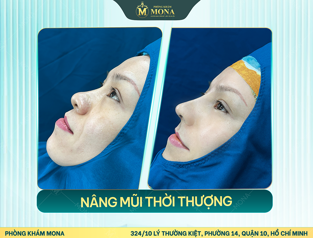 NÂNG MŨI CẤU TRÚC