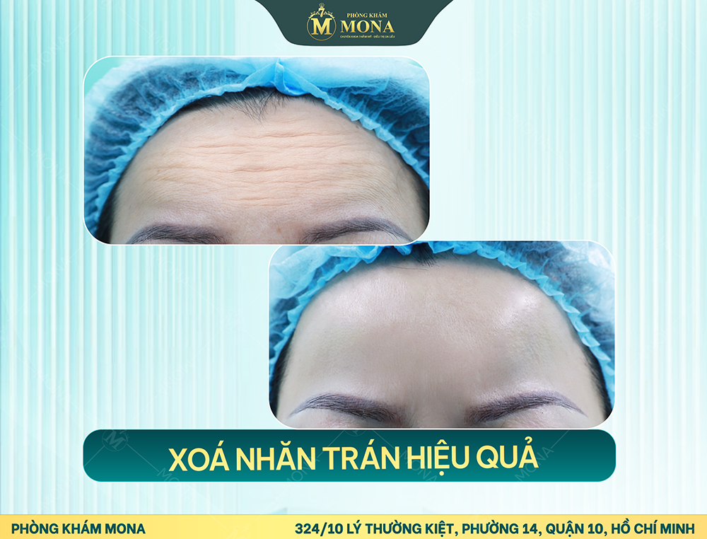 XÓA NHĂN TRÁN